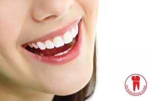 Bọc răng sứ kim loại giúp cải thiện thẩm mỹ