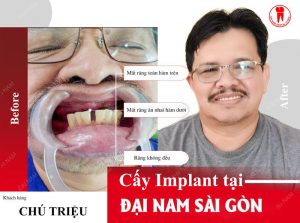 trồng răng implant tại đại nam sài gòn ở đà nẵng