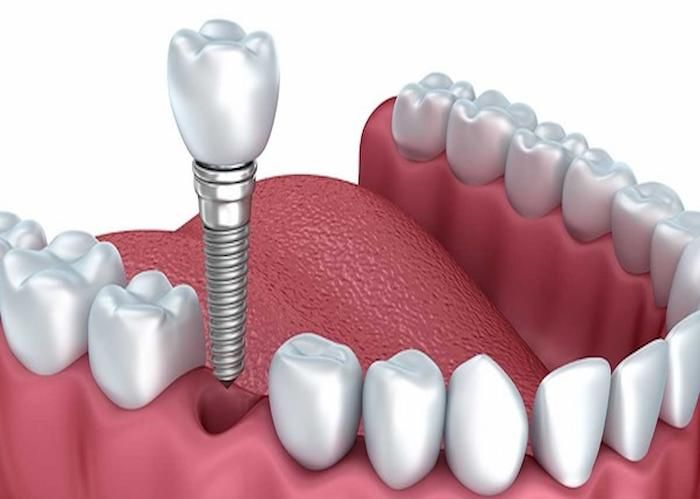 Trồng răng Implant đòi hỏi kỹ thuật rất cao