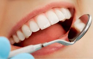 Bọc răng sứ giúp cải thiện tình trạng răng hô vẩu.