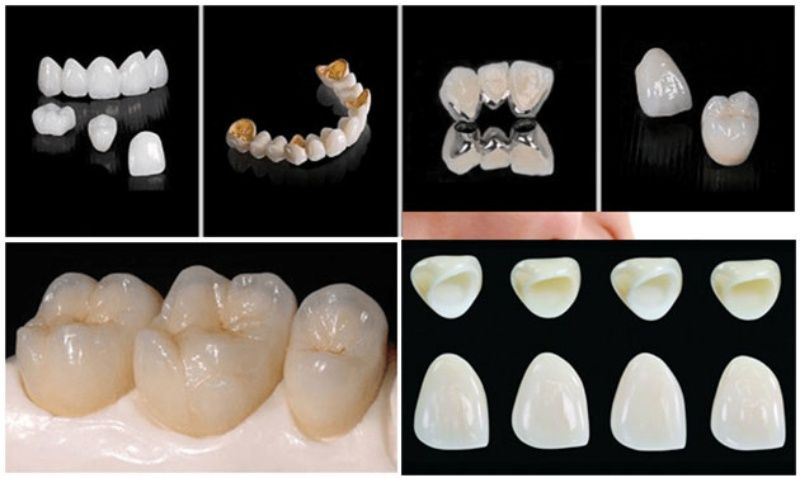 Nhiều loại răng sứ để khắc phục tình trạng hô vẩu