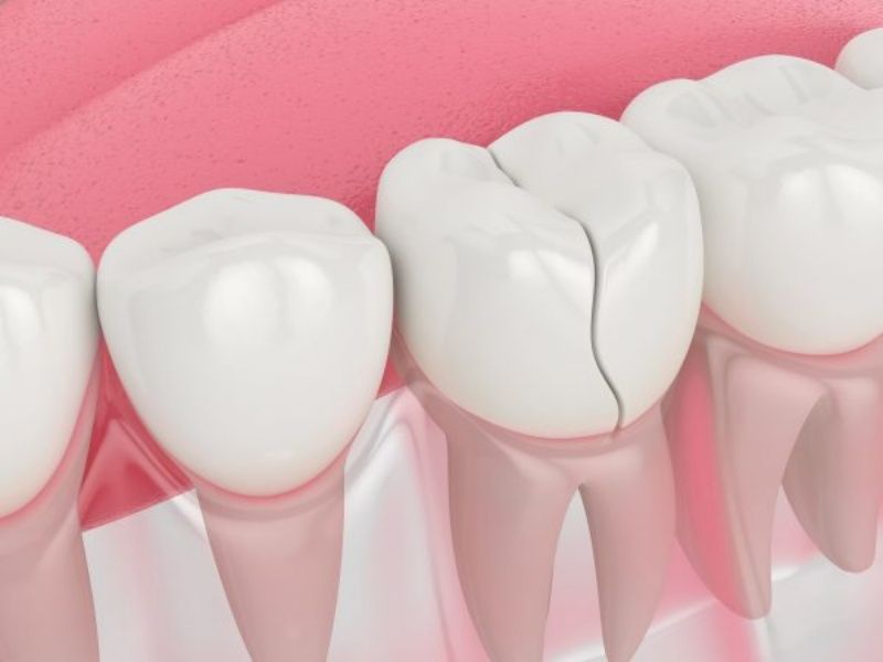 Răng sứ kém chất lượng dễ bị nứt