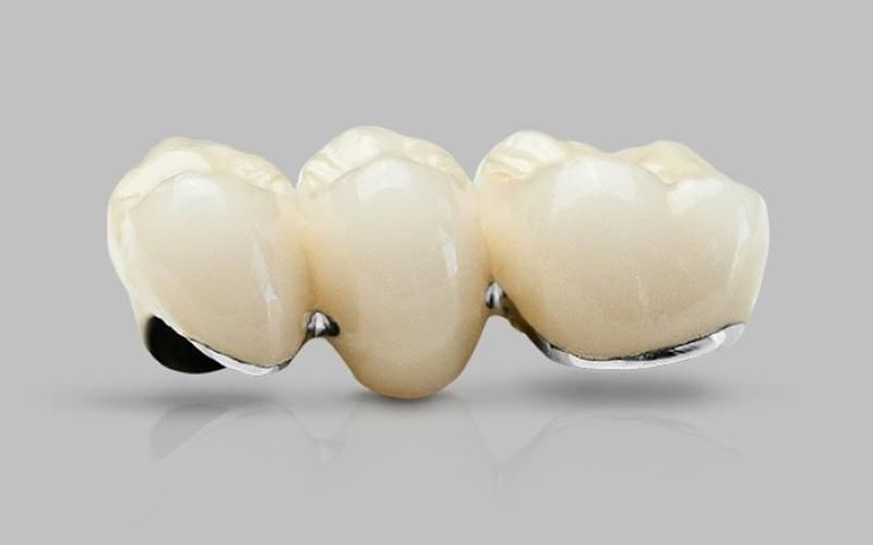 Bọc răng sứ kim loại giúp cải thiện thẩm 