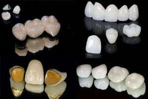 Có nhiều loại răng sứ kim loại với đặc tính khác nhau