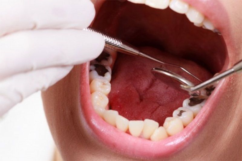 Răng cấm rất dễ bị sâu