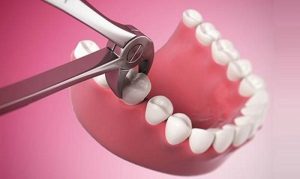 Nhổ bỏ răng cần được thực hiện theo chỉ định của bác sĩ chuyên khoa