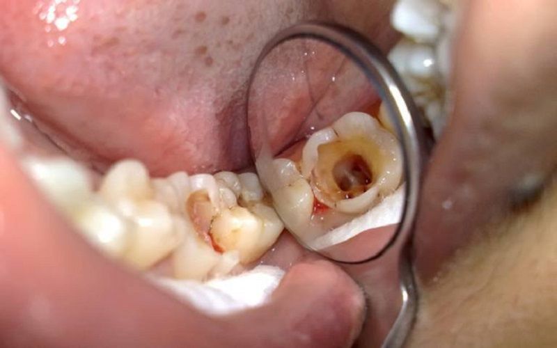 Cần điều trị tủy răng nếu răng bị sâu nặng.