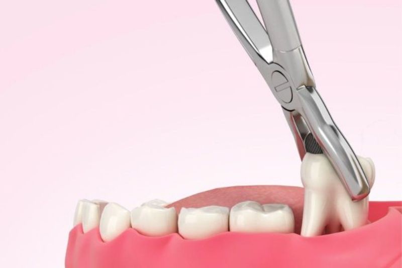 Nên nhổ bỏ răng số 8 bị sâu để hạn chế các ảnh hưởng xấu