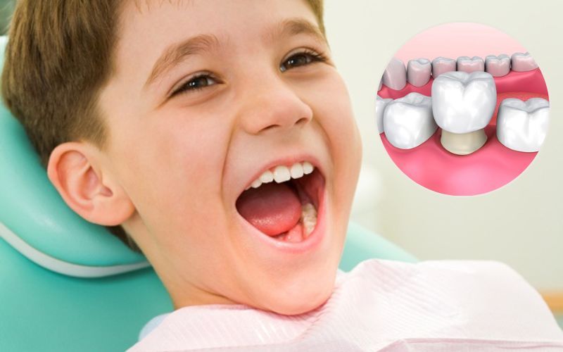 Trẻ nhỏ được khuyến khích bọc răng sứ cho răng sâu ở độ tuổi phù hợp