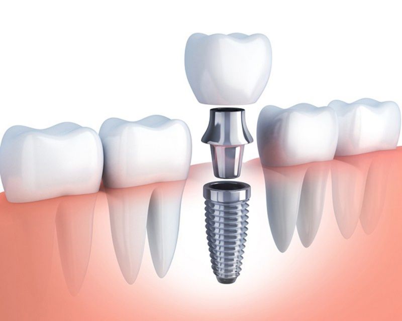 Trồng răng Implant có đau không là nỗi lo ngại của nhiều bệnh nhân
