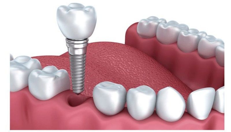 Trồng răng Implant là phương pháp phục hình tối ưu 