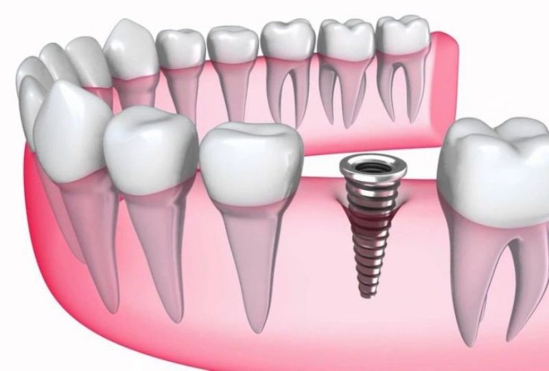 Trồng răng Implant là phương pháp an toàn nếu thực hiện đúng cách