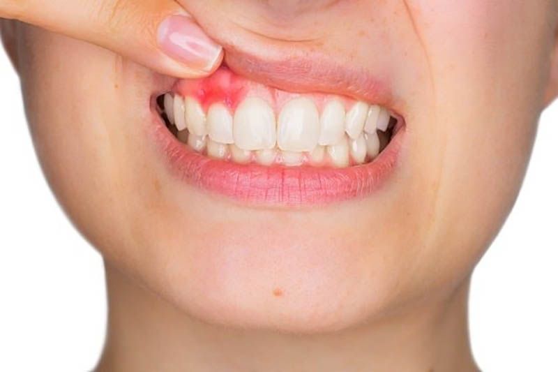 Cần điều trị các bệnh lý răng miệng trước khi cấy ghép Implant