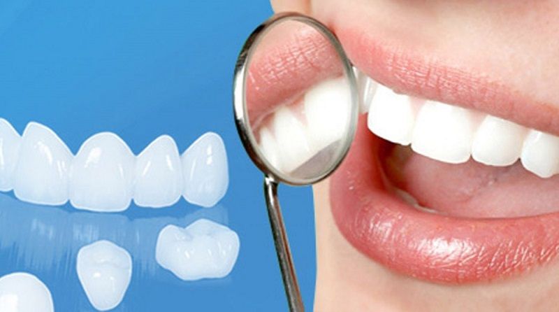 Bọc răng sứ là phương pháp phục hình thẩm mỹ