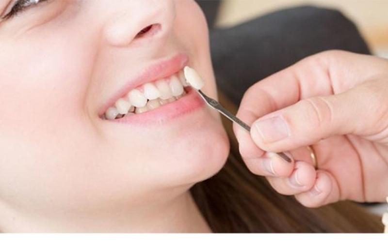 Bọc răng sứ cho răng khểnh giúp cải thiện tính thẩm mỹ