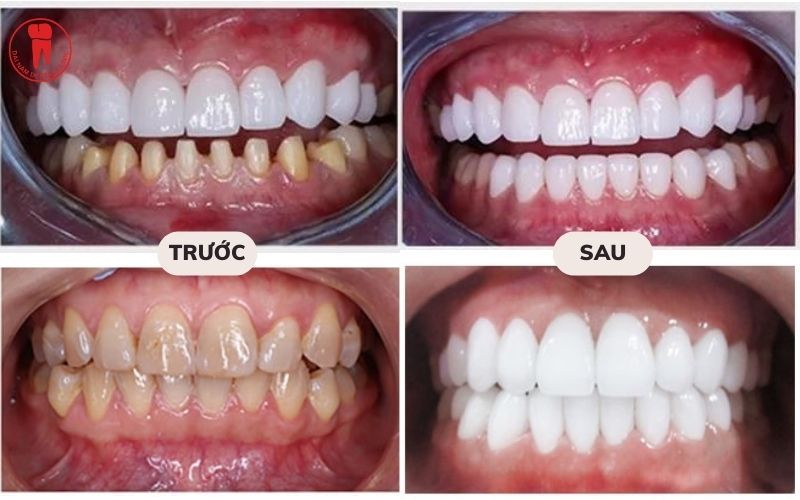 Trước và sau khi bọc răng sứ nguyên hàm tại Đại Nam Sài Gòn