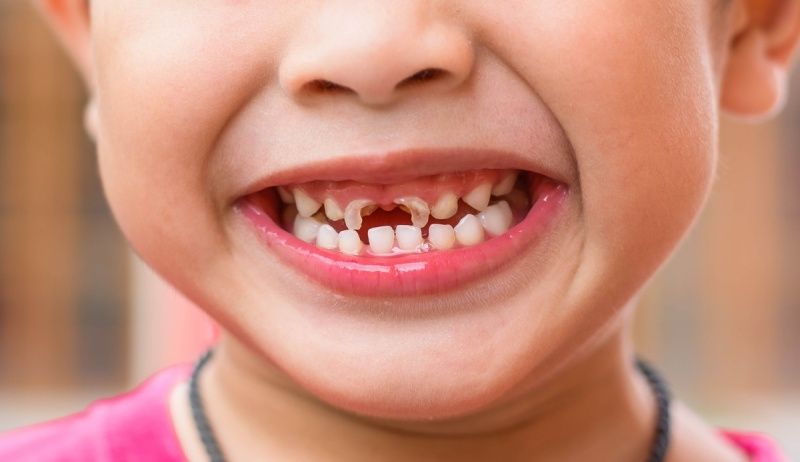 Trẻ em rất dễ bị sâu răng