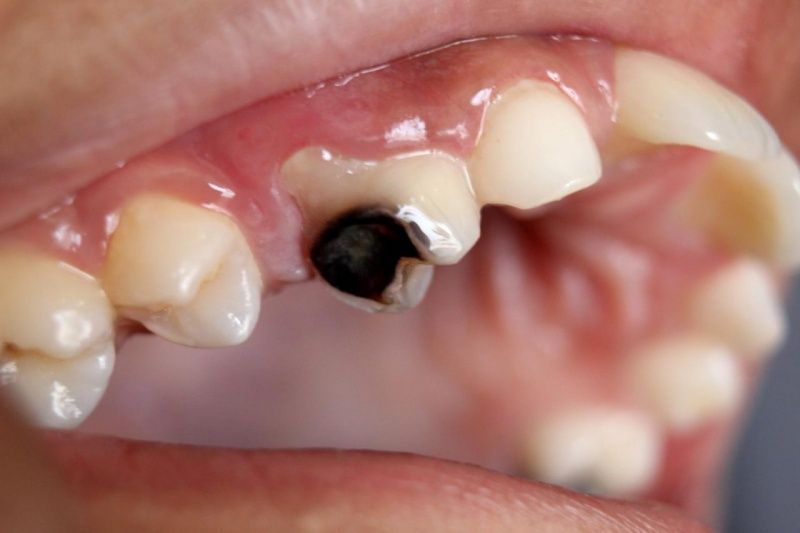Tình trạng sâu răng ở trẻ em