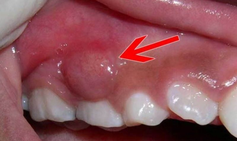 Tình trạng áp xe chân răng