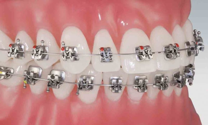 Niềng răng giúp răng lệch lạc về đúng vị trí trên cung hàm