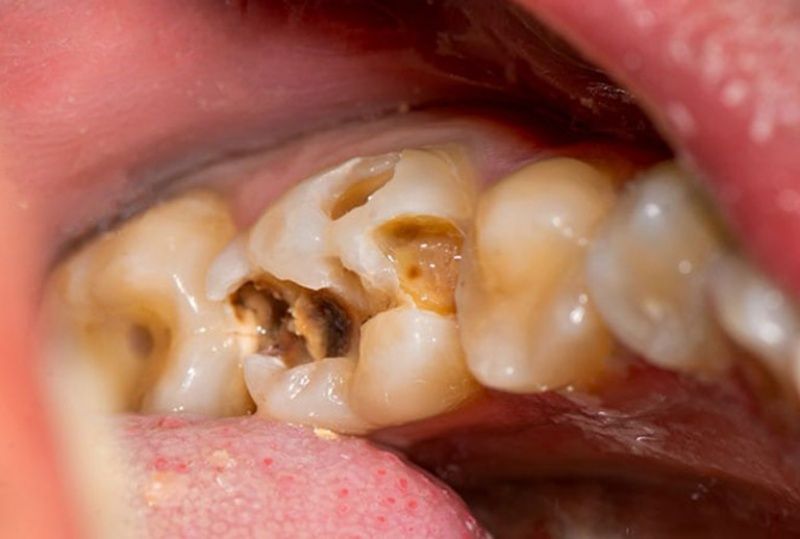 Răng bị sâu ảnRăng hàm bị sâu lung lay  hưởng đến tủy 
