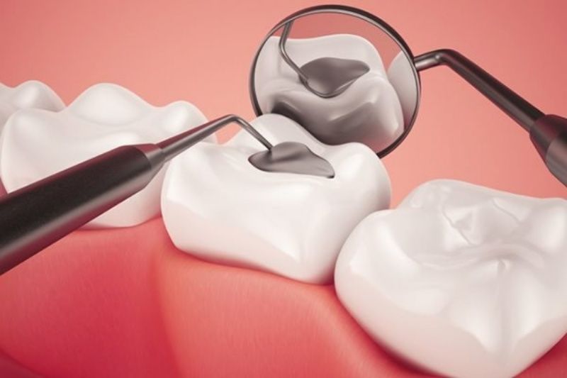 Trám răng là giải pháp cho tình trạng sâu răng