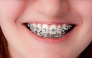 Niềng răng mắc cài kim loại là giải pháp chỉnh nha hiệu quả
