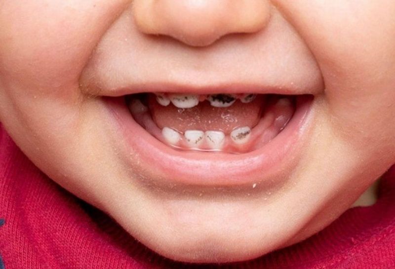 Trẻ bị sâu răng sữa