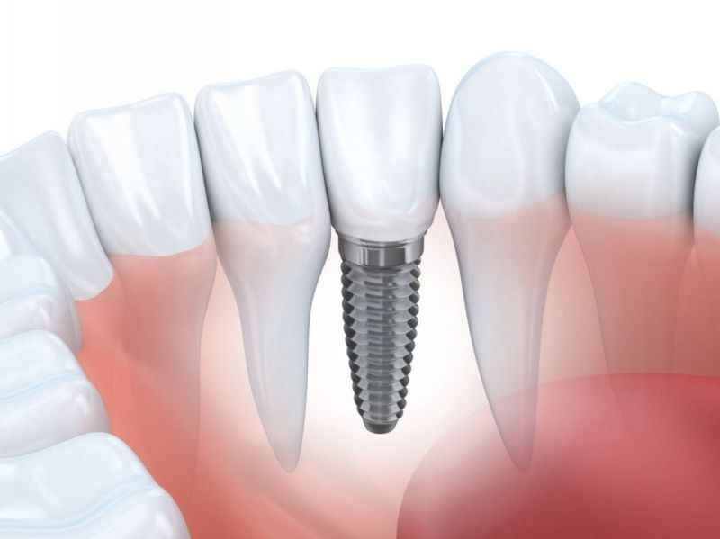 Trồng răng Implant là giải pháp phục hình tối ưu