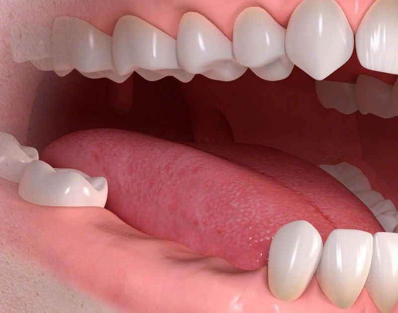 Mất răng ảnh hưởng đến khả năng ăn nhai và thẩm mỹ
