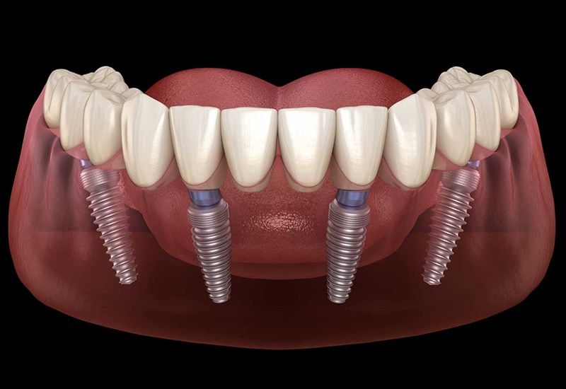 Trồng răng Implant toàn hàm All On 4