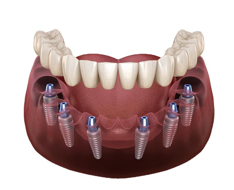 Trồng răng Implant toàn hàm All On 6