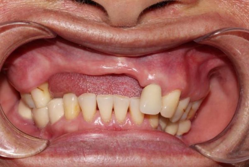 Người mất nhiều răng nên trồng Implant toàn hàm