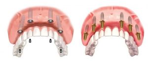 Trồng răng Implant All On 4 và All On 6 đòi hỏi bác sĩ có chuyên môn