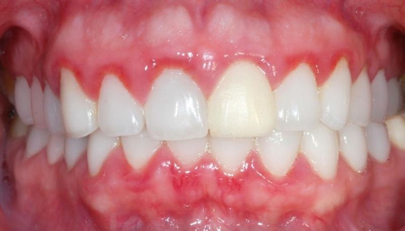 Tình trạng bọc răng sứ bị viêm lợi