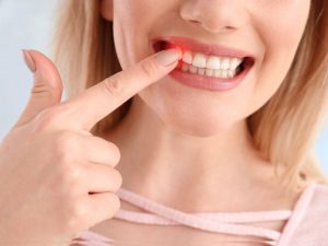 Nhiều người bị kích ứng với răng sứ kim loại