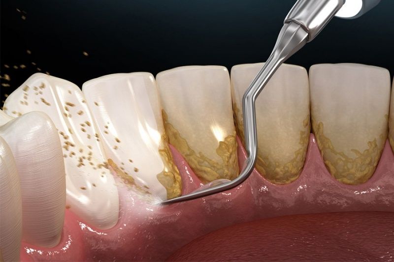 Cạo vôi răng để ngăn ngừa vi khuẩn phát triển