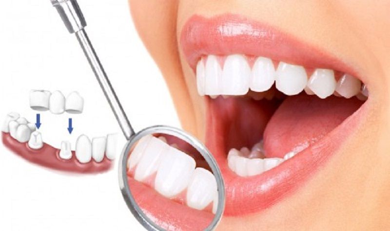 Bọc lại răng sứ mới để hạn chế tình trạng nướu bị sưng viêm