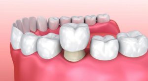 Bọc răng sứ cho răng sâu mang lại hiệu quả cao hơn