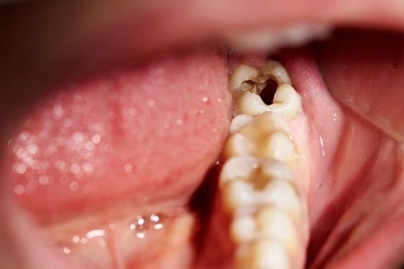 Không phải tình trạng sâu răng nào cũng có thể bọc sứ