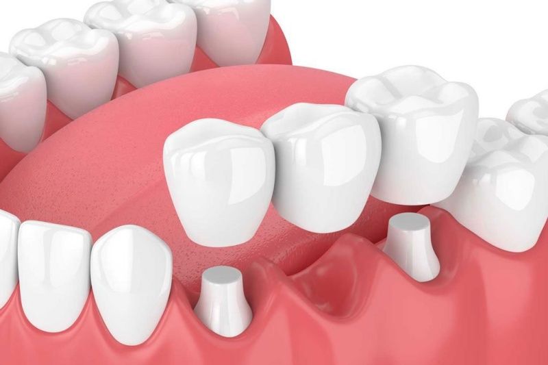 Bọc răng sứ giúp là xu hướng thẩm mỹ răng được ưa chuộng 