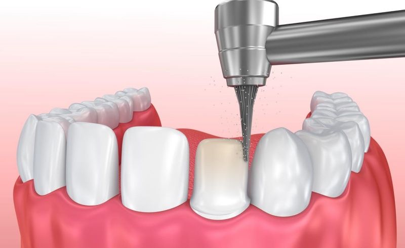 Khi bọc răng sứ thì răng gốc sẽ bị mài theo tỉ lệ nhất định
