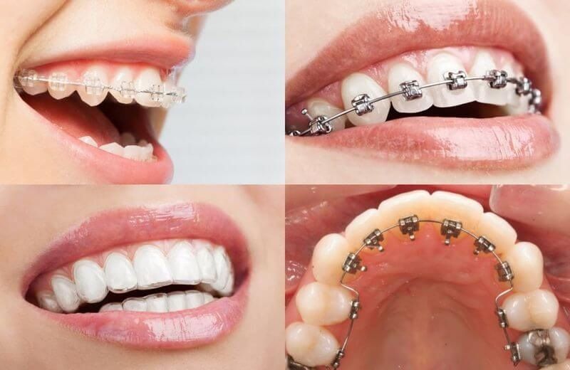 Những phương pháp niềng răng hiện nay