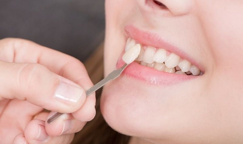 Bọc răng sứ răng cửa nhằm cải thiện thẩm mỹ
