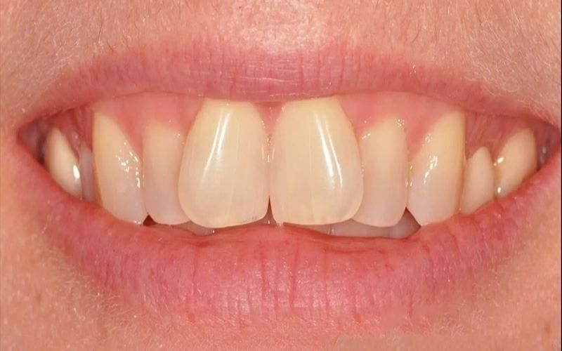 Bọc răng sứ giúp cải thiện tình trạng răng cửa mọc lệch