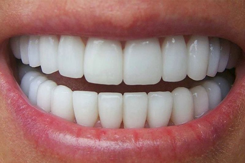 Bọc răng sứ giúp hàm răng trở nên đều đẹp