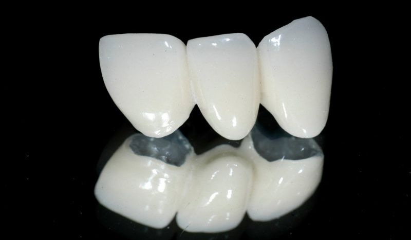 Răng sứ kim loại gây thâm đen viền nướu sau một thời gian 