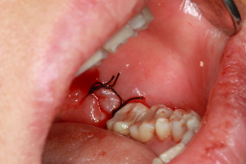 Bác sĩ khâu vết thương sau khi nhổ răng