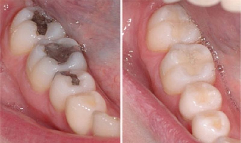 Phương pháp bọc răng sứ giúp bảo tồn răng