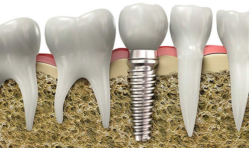 Răng thật và răng Implant khác nhau về kích thước